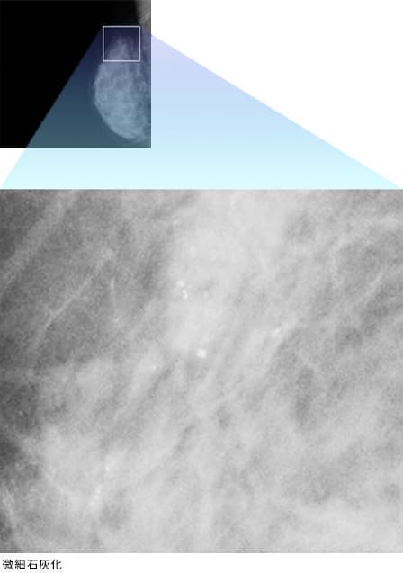 微細石灰化の拡大X線画像