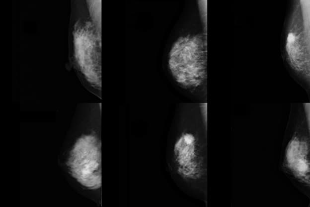 乳がん検査のＸ線画像